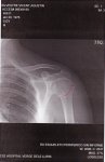 2006 07 07 Rx fractura humero - linea fractura.jpg