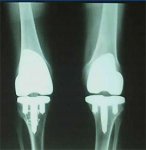 protesis rodilla.jpg