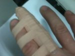 dedo roto.jpg