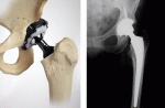 images_protesis.gif