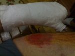 fractura.jpg