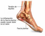 fascitis_plantar.jpg