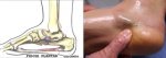 fascitis_plantarb.jpg
