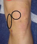 rodilla_lcaB.jpg