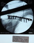 armstrong_xray_20.jpg