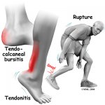 tendinitis de aquiles.jpg