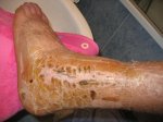 FRACTURA TOBILLO ESTADO 17 01 2007 003.jpg