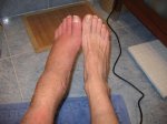 FRACTURA TOBILLO ESTADO 17 01 2007 022.jpg