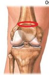 osteoartritis2.jpg