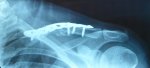 Placa Clavicula1.jpg