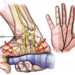 Nervio Ulnar.jpg