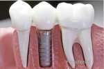 implantes-dentales1.jpg
