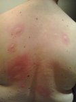 Mi espalda acribillada a mosquitazos.jpg