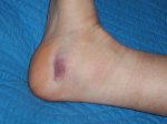 fot esguince pie (reducida).jpg