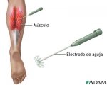 Electromiografía.jpg
