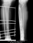 Perone Tibia_060720140533.jpg