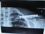 20131025_radiografia_clavicula_IMG_9304.JPG