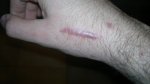fractura Bennett.jpg