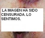 hemorroides1.jpeg