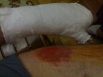 fractura foro.JPG