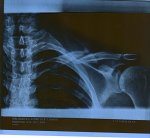 Radiografia 1 mes despuÃ©s de la caida.jpg