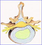 herniasup2_g.gif