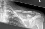 clavicula[1].jpg